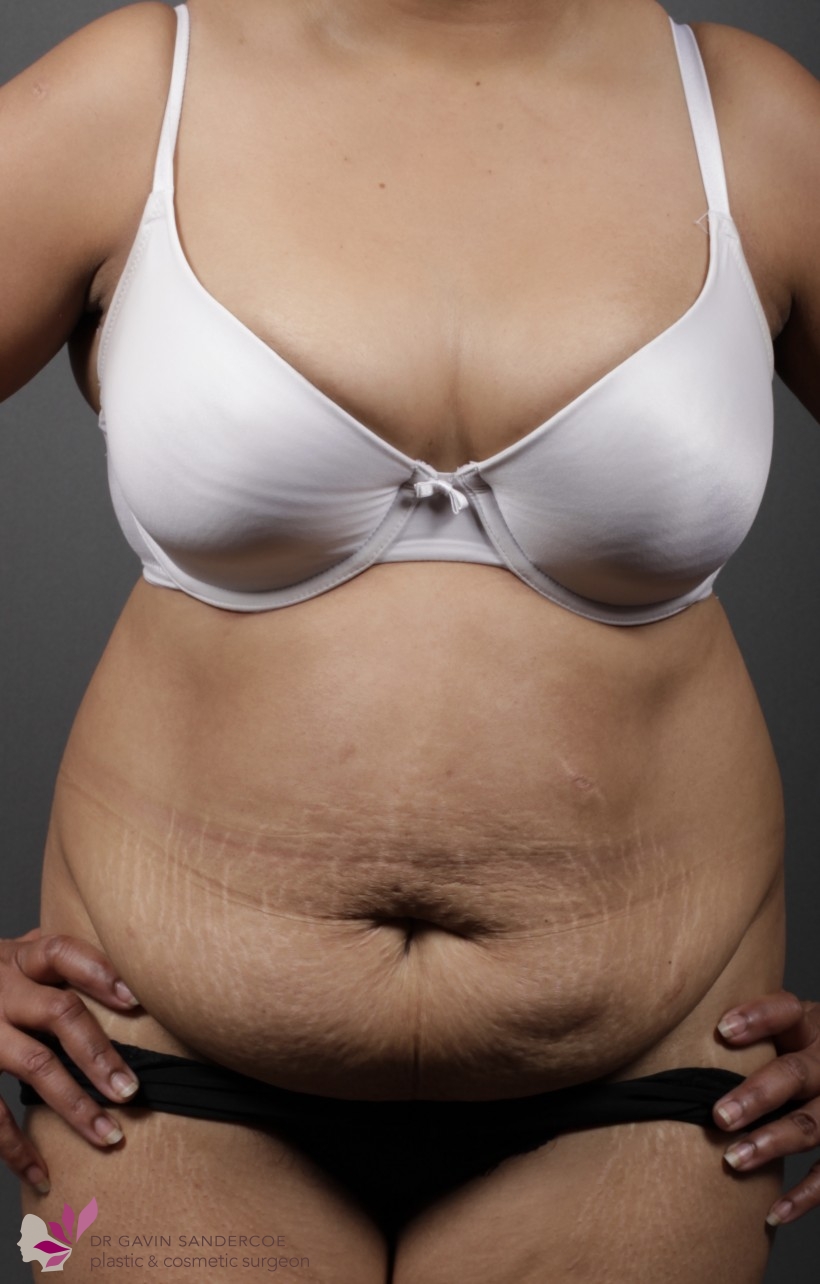 abdominoplasty pregnancy before dr gavin sandercoe