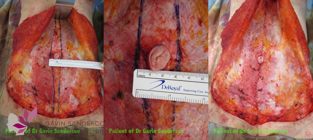 Operative details of patient 1