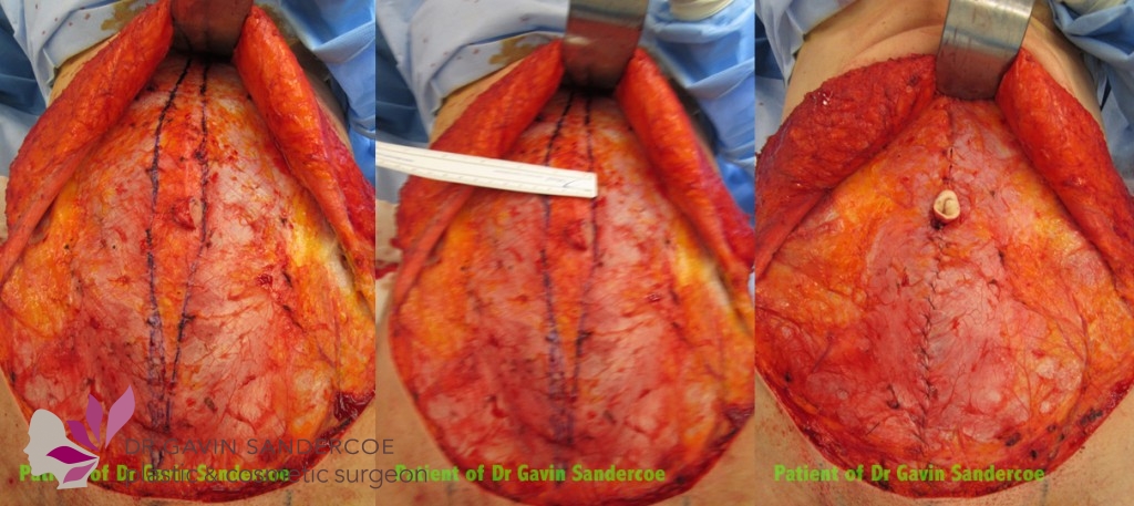 Patient B: Operative details of rectus divarication repair